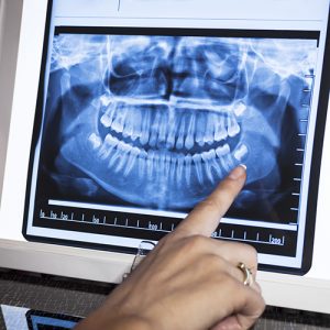 Panoramic X Ray